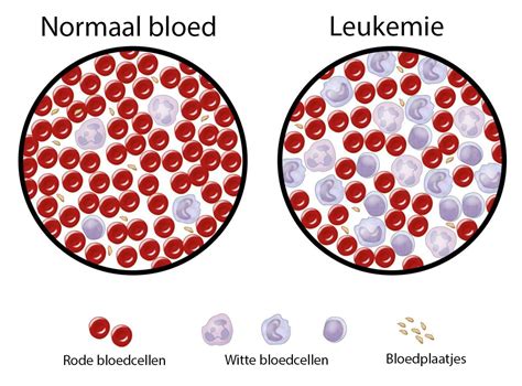 Acute leukemie